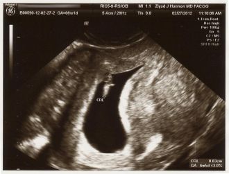 Decollement Placenta Debut Grossesse Thromna89ciswill